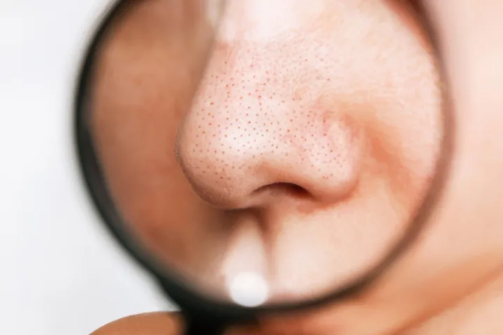 nose pores unclog