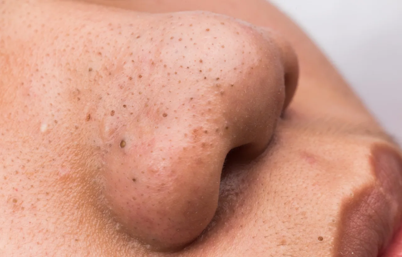 unclog pores on face